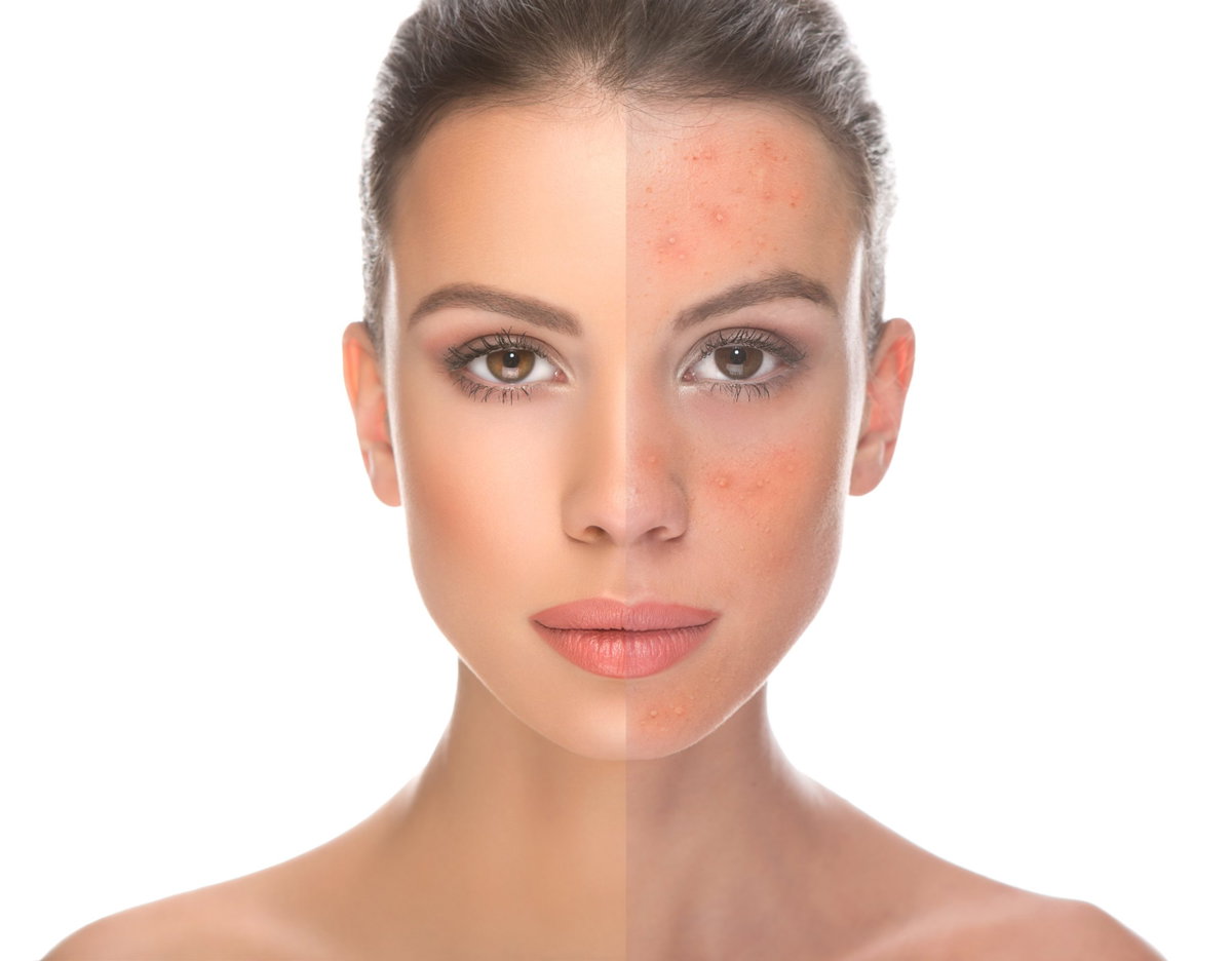 Vorher Nachher mit Exosomen, Exosomenbehandlung, Exosomen Therapie, Biorevitalisierung