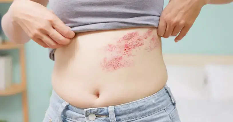Herpes zoster auf der Haut mit einseitigem Ausschlag und gruppierten Bläschen