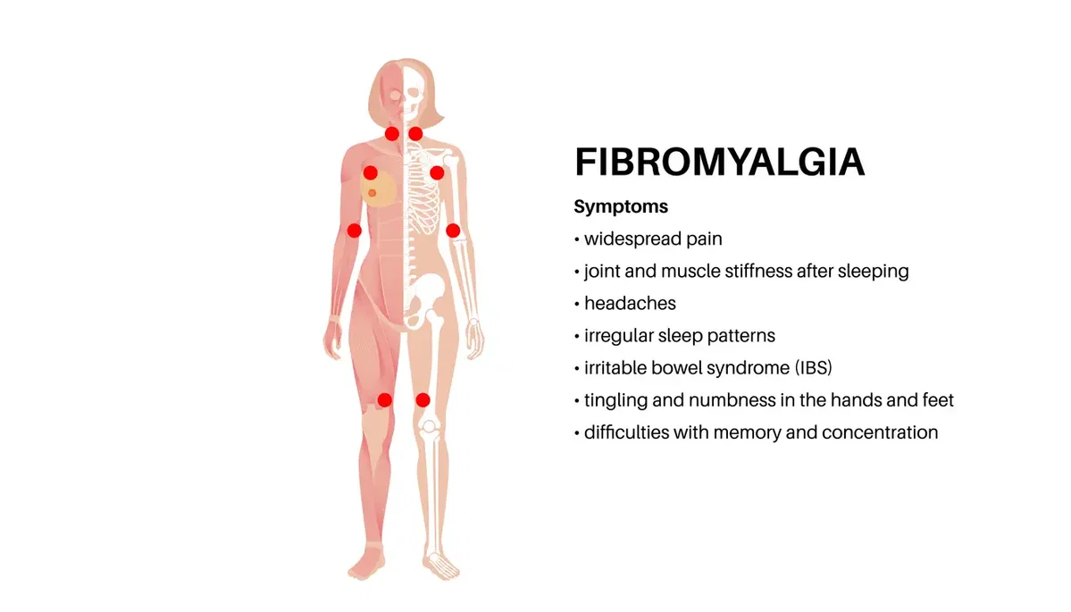 Fibromyalgie-Symptome Schaubild – Körperregionen und typische Schmerzverteilung