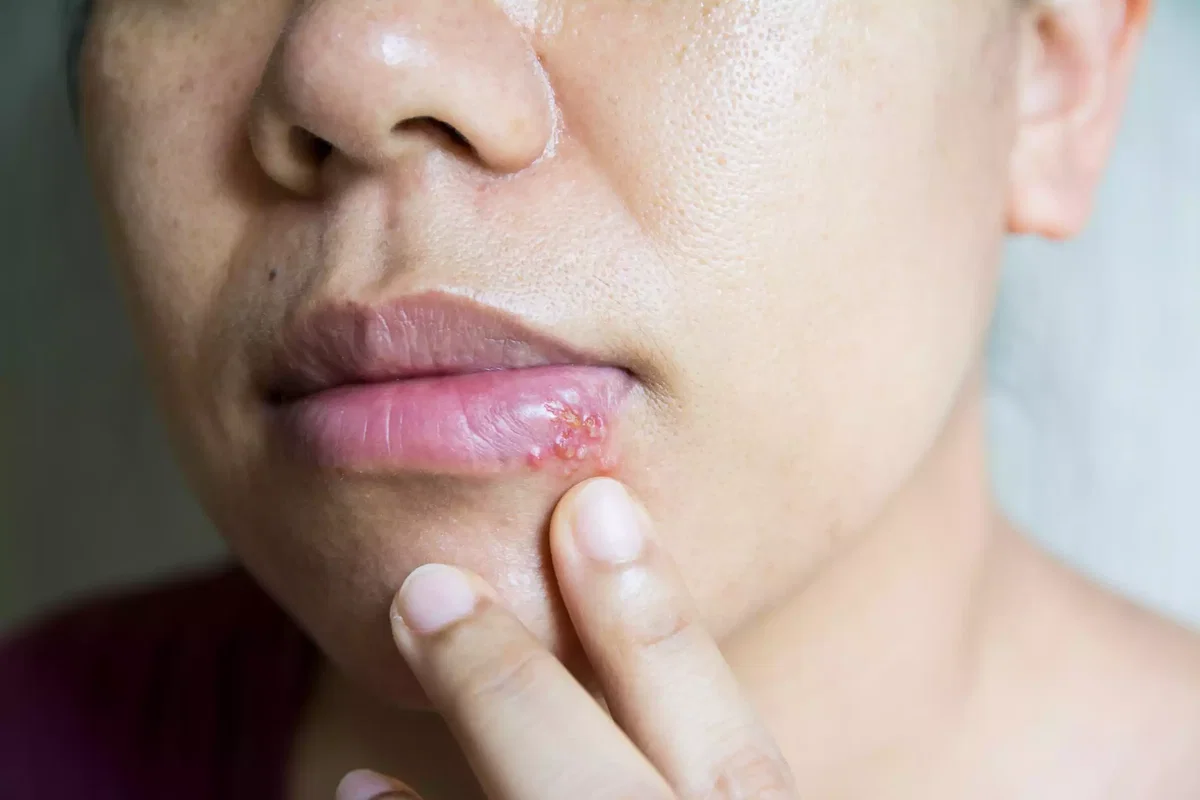 Lippenherpes mit gruppierten Bläschen an der Lippe im typischen Verlauf