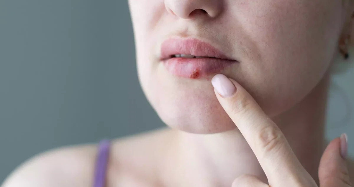 Lippenherpes an der Lippe im Anfangsstadium mit typischem Kribbeln und früher Bläschenbildung